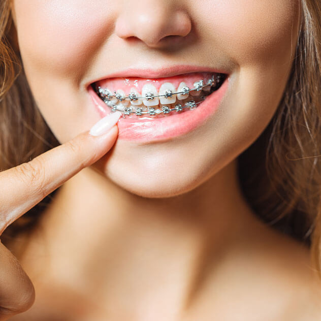 What are SureSmile braces?